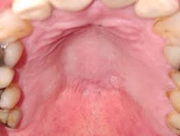 Hpv can infect the mouth and throat and cause cancers of the oropharynx (back of the throat, including the base of the tongue and tonsils). Squamous Cell Papilloma Dermnet Nz