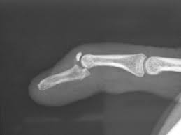 They are the most prevalent finger tendon injury in sport. Mallet Finger Fracture Radiology Notes