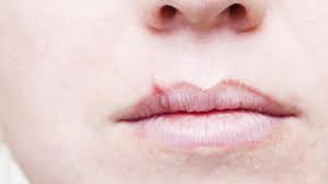 Be watchful for any new or changing lesions on your skin and look out for these warning signs. What Is The First Sign Of Lip Cancer