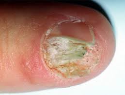 If you aren't sure which type of skin cancer. Intraepidermal Squamous Cell Carcinoma Dermnet Nz
