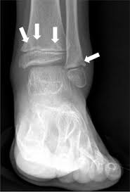 Image result for Osteomyelitis XRay