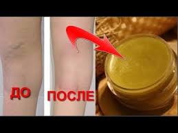 как узнать что у тебя глисты в домашних условиях Kak Ya Vylechila Varikoz Na Nogah Bescennyj Recept Mazi Otvety Na Voprosy Varikoz Zdorove Celebnye Travy