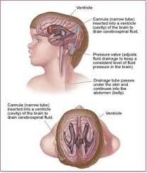 Hydrocephalus Is A Buildup Of Fluid Inside The Skull That Leads To Brain Swelling Hydrocephalus Means Water On The Brain Http Www Nlm Nih Gov Medlineplu
