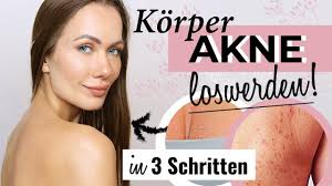 Pickelmale sind im grunde nichts anderes als pigmentflecken, die uns der pickel nach dem heilungsprozess großzügig hinterlässt. Pickel Am Rucken Brust Arm Loswerden So Habe Ich Es Geschafft Youtube