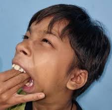 Surgical resection of a bilateral temporomandibular joint ankylosis and  interposition gap arthroplasty using bilateral temporo-p