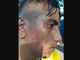 Walter Guevara, del Limeño, termina con un corte en el rostro tras juego  con Alianza