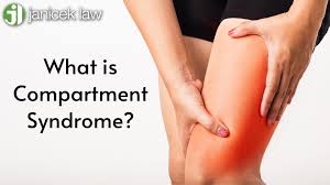Image result for Compartment Syndrome