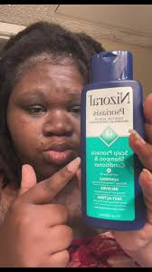 Double Shampoo After Nizoral