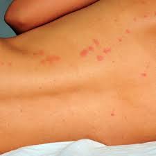 5 Types Of Bug Bites Causes Of Bug Bite Rashes Bed bug bites occur at night, as these creatures prefer feeding on sleeping hosts. 5 types of bug bites causes of bug