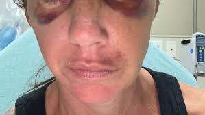 Fundraiser by Ashly Guardino : Recovery from a violent assault in murrieta