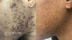 A laser hair removal treatment can eliminate these hairs under the skin in 6 to 8 sessions, spread over a period of 18 months. Ingrown Hair Removal Pulse Light Clinic London