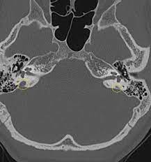 Demystifying Enlarged Vestibular Aqueduct Syndrome University Hospitals