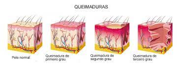 Type of injury to skin. 7Âº Grupamento De Resgate Queimaduras De 1 2 E 3 Grau