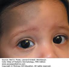 Image result for nevus sclerae