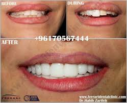 Pin On Hollywood Smile Beirut Lebanon New Website