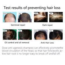 It contains a unique profile of amino acids that provide the building blocks for healthy skin, hair, and nails. Buy Cutelove Anti Hair Loss Drops And Shampoo Natural Growth Essence Set Treat Baldness Damaged Hair Care Remove Dandruff Nourish Scalp Enhance Hair Density And Growth For Women And Men Online In Vietnam