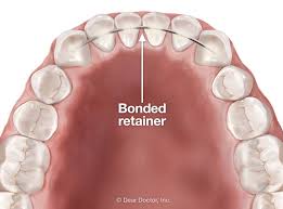 For a retainer that's bent or has moved, don't attempt to fix the problem yourself. Bonded Retainers Pros And Cons