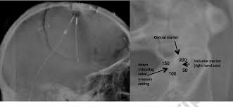 We did not find results for: Figure 6 From Imaging Of Ventricular Shunts Semantic Scholar