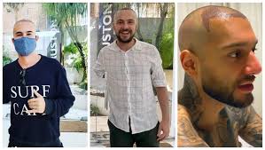 Andréa sorvetão passou por uma transformação no visual e mostrou seu antes e depois no instagram, mas eis que dois dias depois, paulo gustavo precisou passar por uma pleuroscopia, para que a equipe médica pudesse verificar a. Tecnica De Implante Traz Cabelo De Famosos De Volta Veja