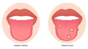 Image result for cancer tongue symptoms)