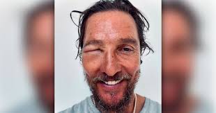 Matthew McConaughey Bee Sting: Is His Eye Okay?