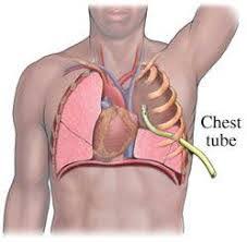 تعبیه چست تیوپ یا درن | خدمات پرستاری نوین