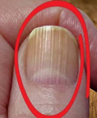 What Vertical Lines on Your Nails Can Reveal About Aging👇💬