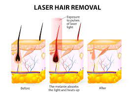 Laser hair removal is not the only procedures for removing hair while pregnant. Undergoing Laser Hair Removal During Pregnancy Is It Safe