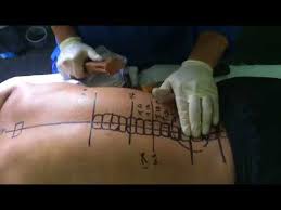 Read about the herination facts on spine and neuro surgery hospital india. Rawatan Slip Disc 2 Youtube