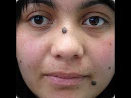But, these seemingly harmless spots on the skin may be hiding a deadly disease: . Dermtv What Is A Mole Dermtv Com Epi 420 Youtube