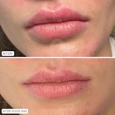 What You Need To Know About Lip Filler Migration | Tannan Plastic Surgery