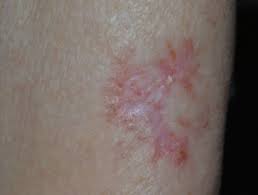Bcc and scc are the two most common types of skin cancer. Basal Cell Carcinoma Affecting Arms And Legs Images Dermnet Nz