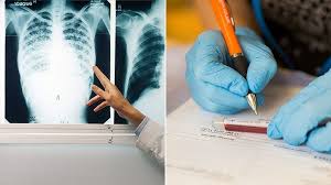 Image result for Tuberculosis Screening