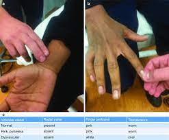 Nov 19, 2019 · capillary refill test: 4 Vascular Assessment Of Upper Extremity A Distal Blood Flow The Download Scientific Diagram