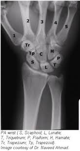Image result for Wrist XRay