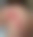 Image result for Pyoderma Gangrenosum