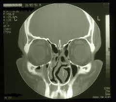 Coronary Paranasal Sinus Computer Tomography Pronounced Angled Download Scientific Diagram