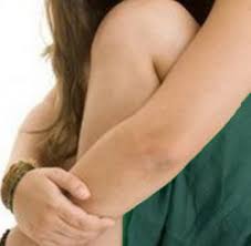 This helps remove the darker skin patches leading to a more even and brighter complexion. Handy Tips To Get Rid Of Dark Elbow And Knees