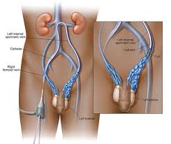 Testicular cancer arises from the testes (a part of the male reproductive system). Understanding Potential Causes Of Testicular Pain Azura Vascular Care