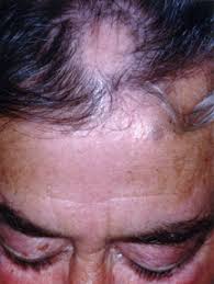 Physical hair damage or defect (eg, trichotillomania, loose anagen syndrome, monilethrix, and overprocessing) androgenetic alopecia is by far the most common form of hair loss, followed by telogen. Hair Loss Harvard Health