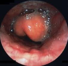 Image result for Epiglottitis