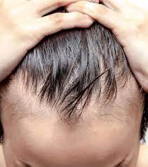 Primeiros Sinais Da Calvicie Como Identificar Marco Da Moda Cabelo Caindo Cabelo Sinais