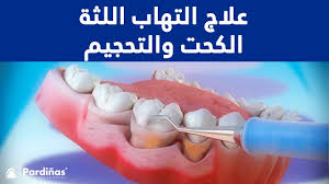 علاج التهاب اللثة الكحت والتحجيم C Youtube