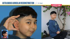Nadia's New Ear** 👂 Nadia is an amazing 7‑year‑old girl from Russia with  Grade 3 right‑sided unilateral microtia. She received her first stage ear  reconstruction at Dr. Mutaf International Microtia Clinic. Dr. Mutaf