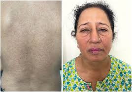 Mucocutaneous manifestations of chikungunya fever: an update