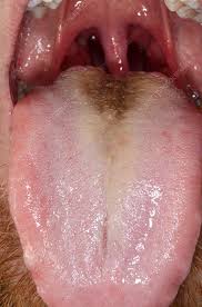Image result for black hairy tongue symptoms