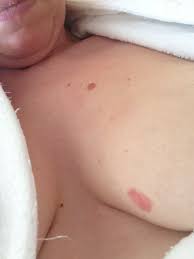 It is referred to as inflammatory due to its frequent presentation with symptoms resembling a skin inflammation, such as erysipelas. Breast Cancer Topic Trying Not To Worry But Worried Any Advice