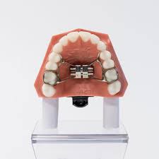 Bite blocks are tiny devices that an orthodontist attaches to your front or back teeth to keep your upper and lower teeth from coming into contact with each other when you bite down. Banded And Bonded Expanders Appliances For Widening The Upper Jaw