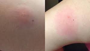 We did not find results for: Mite Bites A Growing Problem In Oklahoma This Fall Ktul