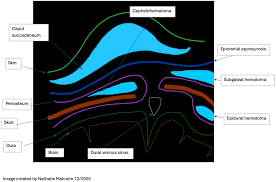 Image result for Cephalhematoma